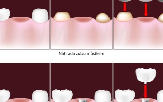 Dentální implantát nebo můstek?