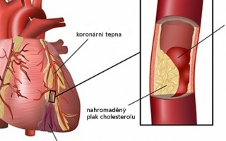 Infarkt myokardu