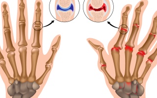Revmatoidní artritida prstních kloubů