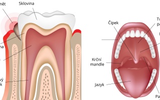 Zánět dásně
