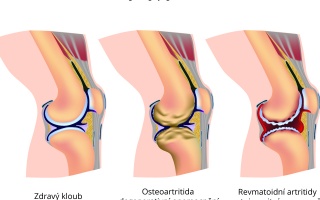 Rozdíly mezi osteoartritidou a revmatickou artriditou