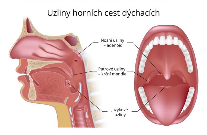 Uzliny horních cest dýchacích