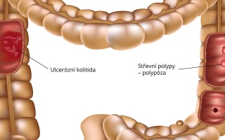 Choroby tlustého střeva