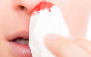 Krvácení z nosu