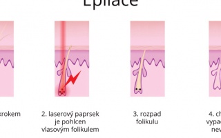 Laserová epilace