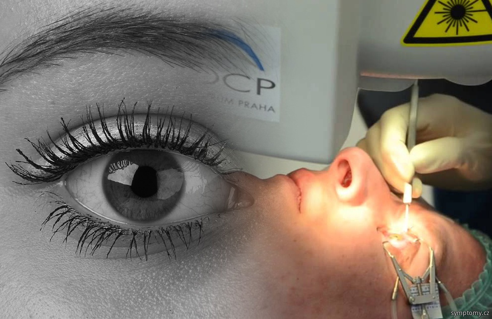 laserová operace oka