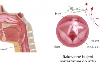 Metastázy