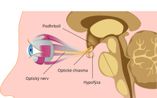 Adenom hypofýzy 