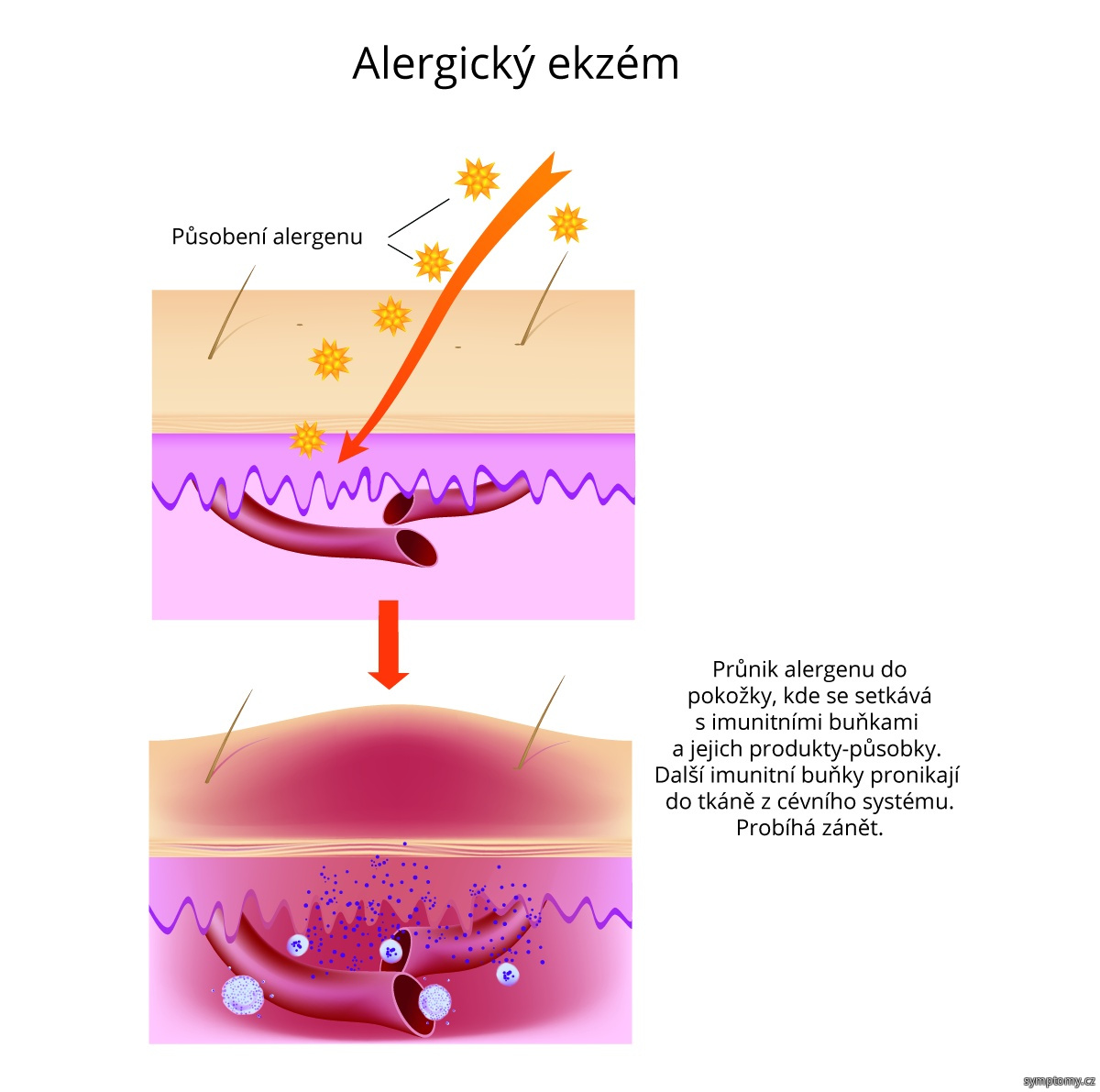 Alergický ekzém