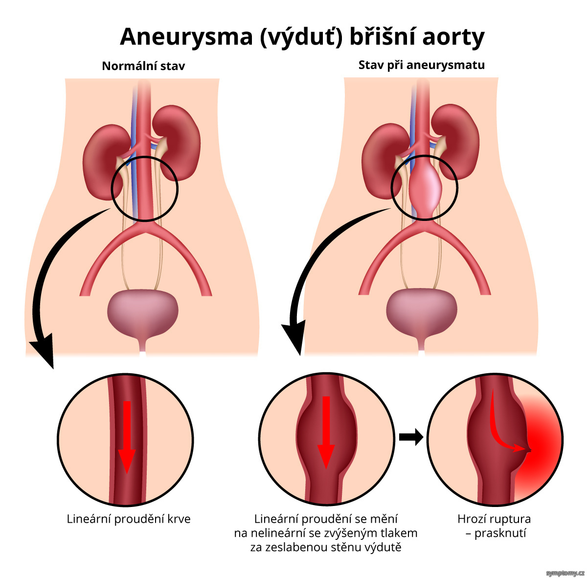 Aneurysma (výduť) břišní aorty
