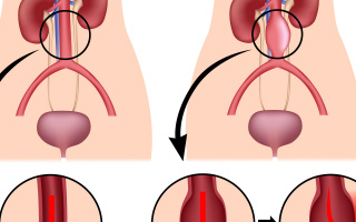 Aneurysma břišní aorty