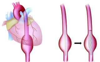 Aneurysma hrudní aorty