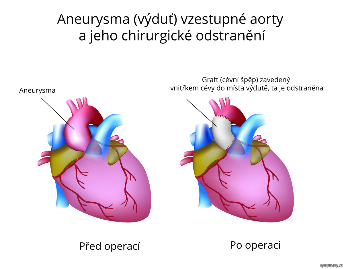 Co je to aneurysma?