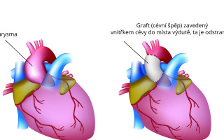 Aneurysma