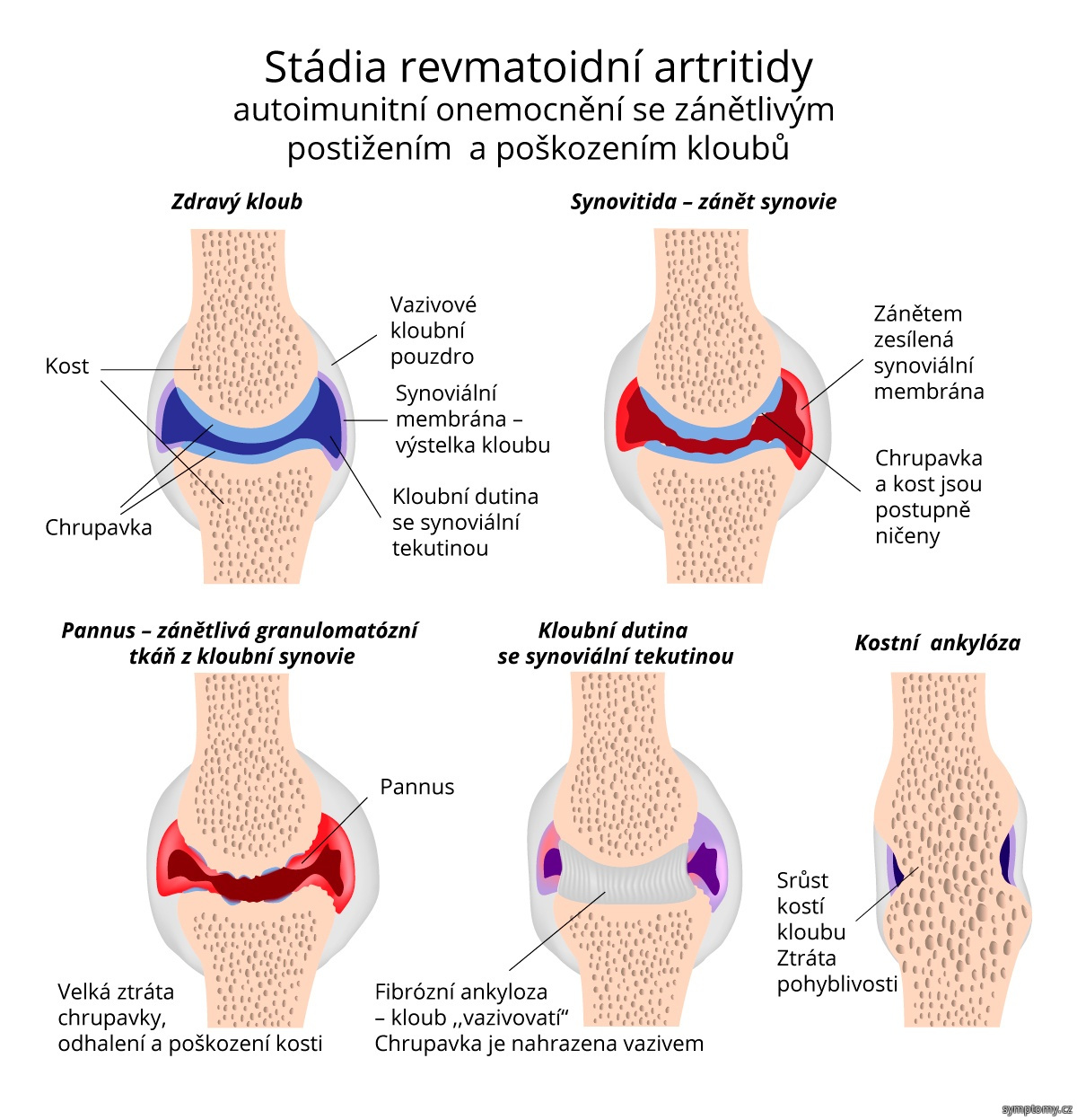 Stádia revmatoidní artritidy
