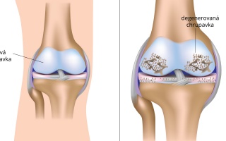 Artróza kolenního kloubu