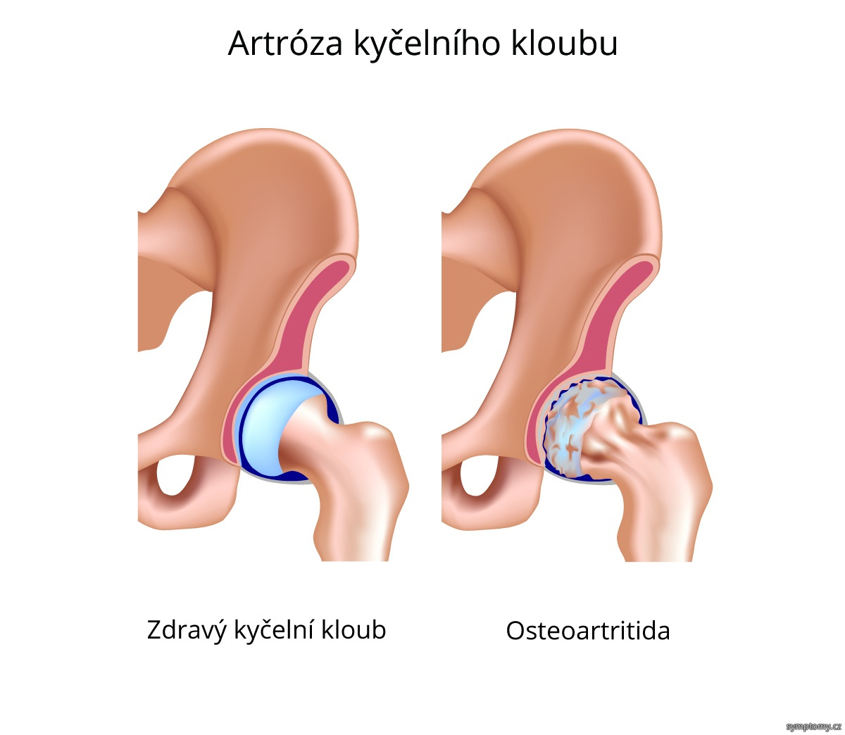 artróza a mléko