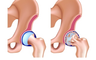 Artróza kyčelního kloubu