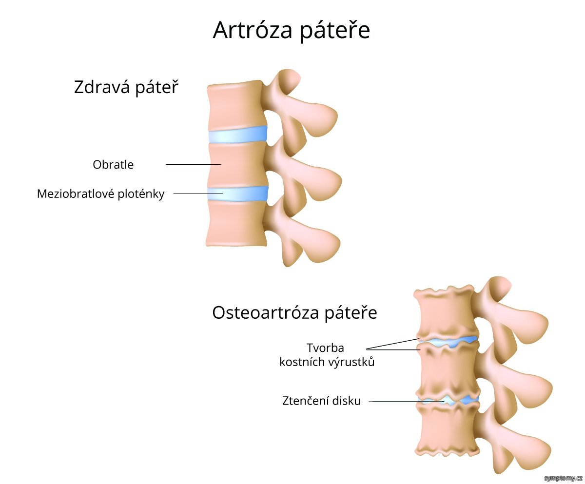 artróza páteře