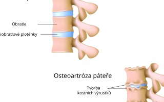 poúrazová artróza