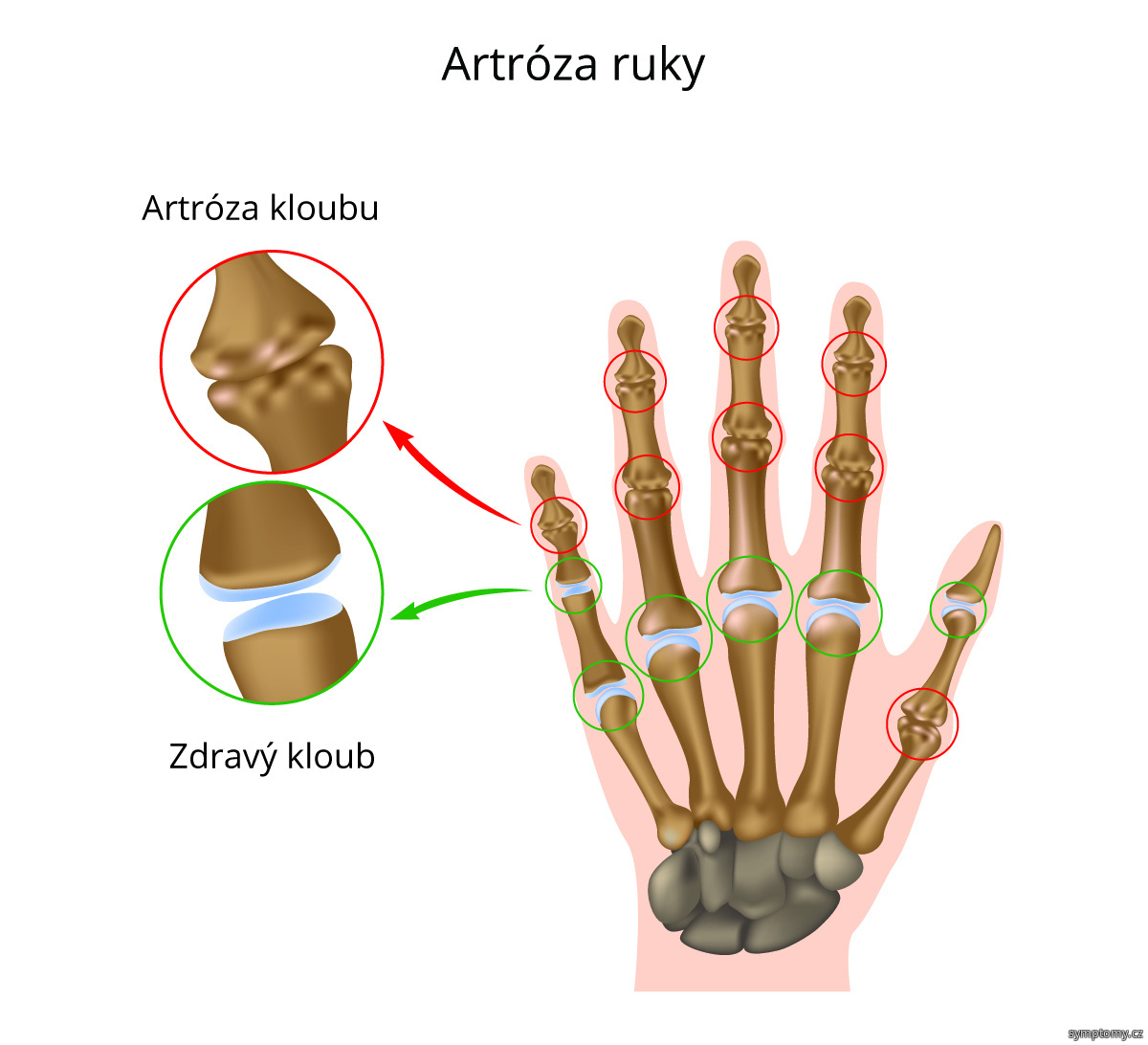 Jak se léčí artróza rukou?