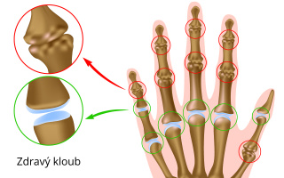 Artróza ruky