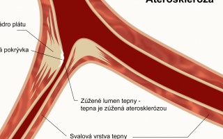 Ateroskleróza