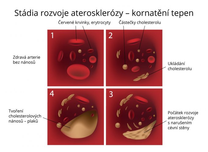 Stádia rozvoje aterosklerózy