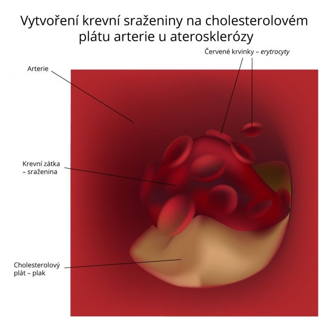 Vytvoření krevní sraženiny na cholesterolovém plátu arterie u aterosklerózy