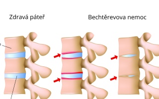 Bechtěrevova nemoc