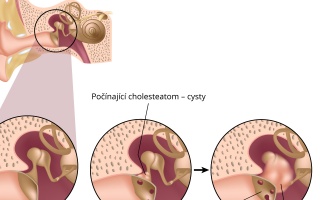 Cholesteatom