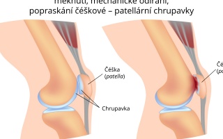 Chondromalácie čéšky