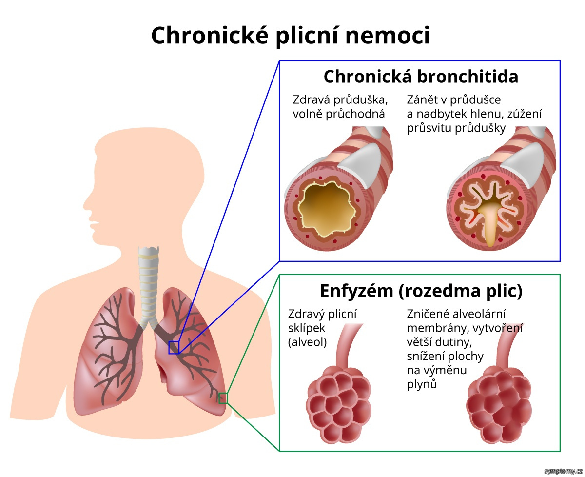 Chronické plicní nemoci