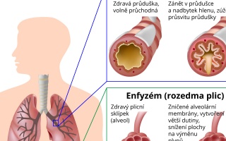 Chronická obstrukční plicní nemoc (CHOPN)