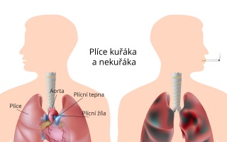 Chronická obstrukční plicní nemoc (CHOPN)