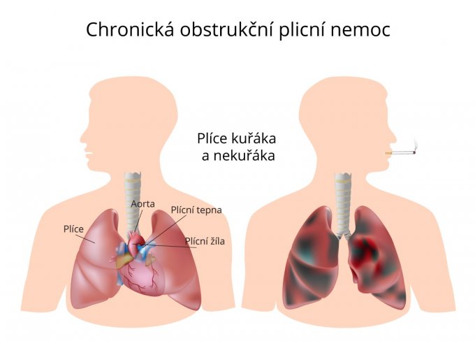 Plíce při chronické obstrukční plicní nemoci