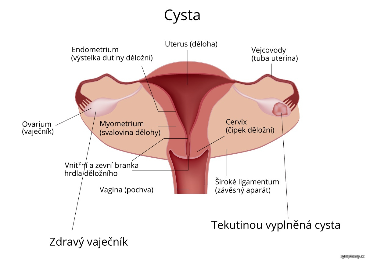Ovariální cysta