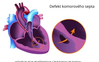 Defekt komorového septa