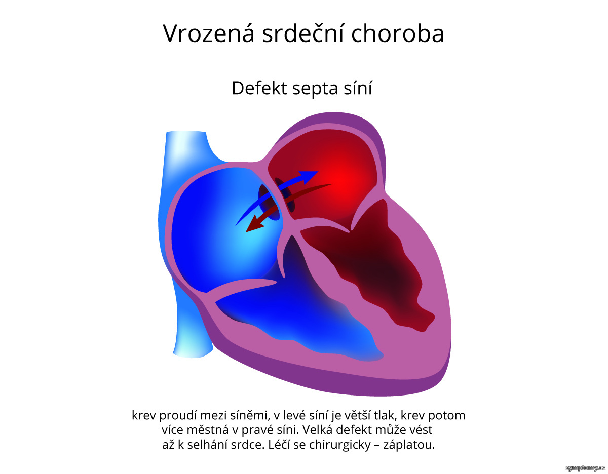 Vrozená srdeční choroba - defekt septa síní