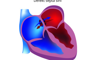 Defekt síňového septa (ASD)