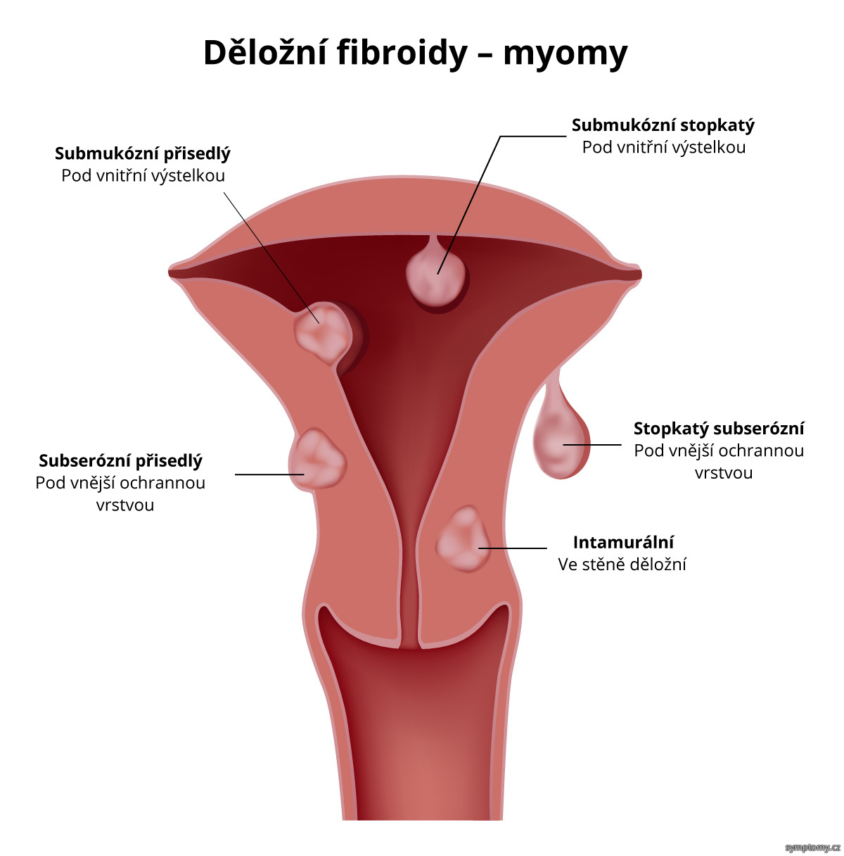 Děložní fibroidy---myomy