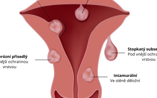 Děložní myomy (leiomyomy)