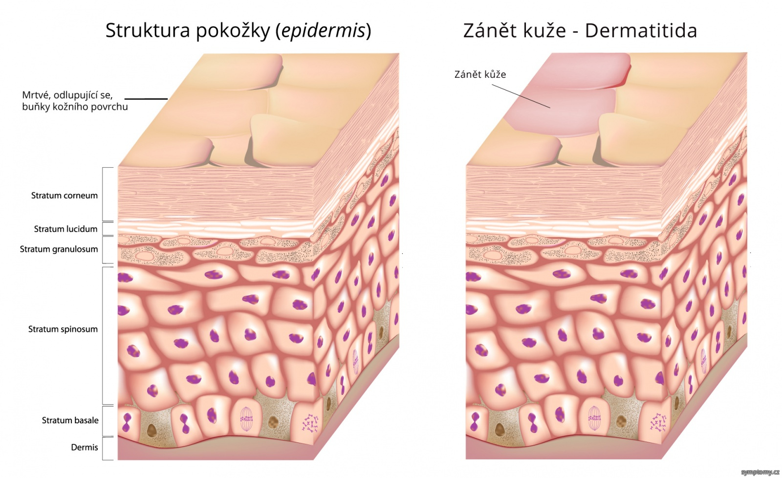 Dermatitida - zánět kůže