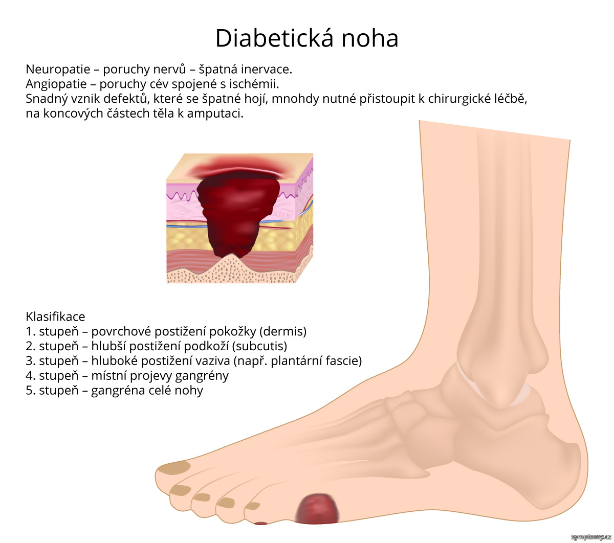 Diabetická noha