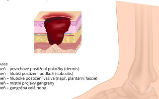 Diabetická noha