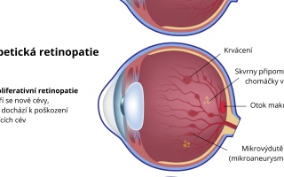 Diabetická retinopatie