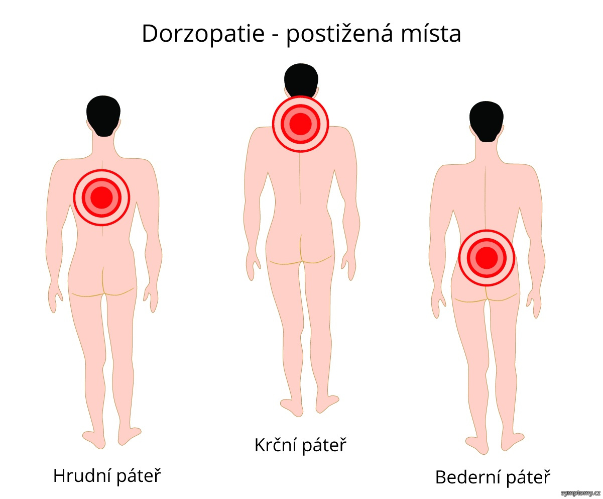 Dorzopatie - postižená místa