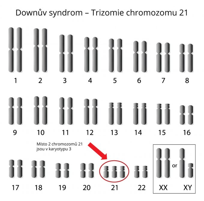 Trizomie chromozomu 21