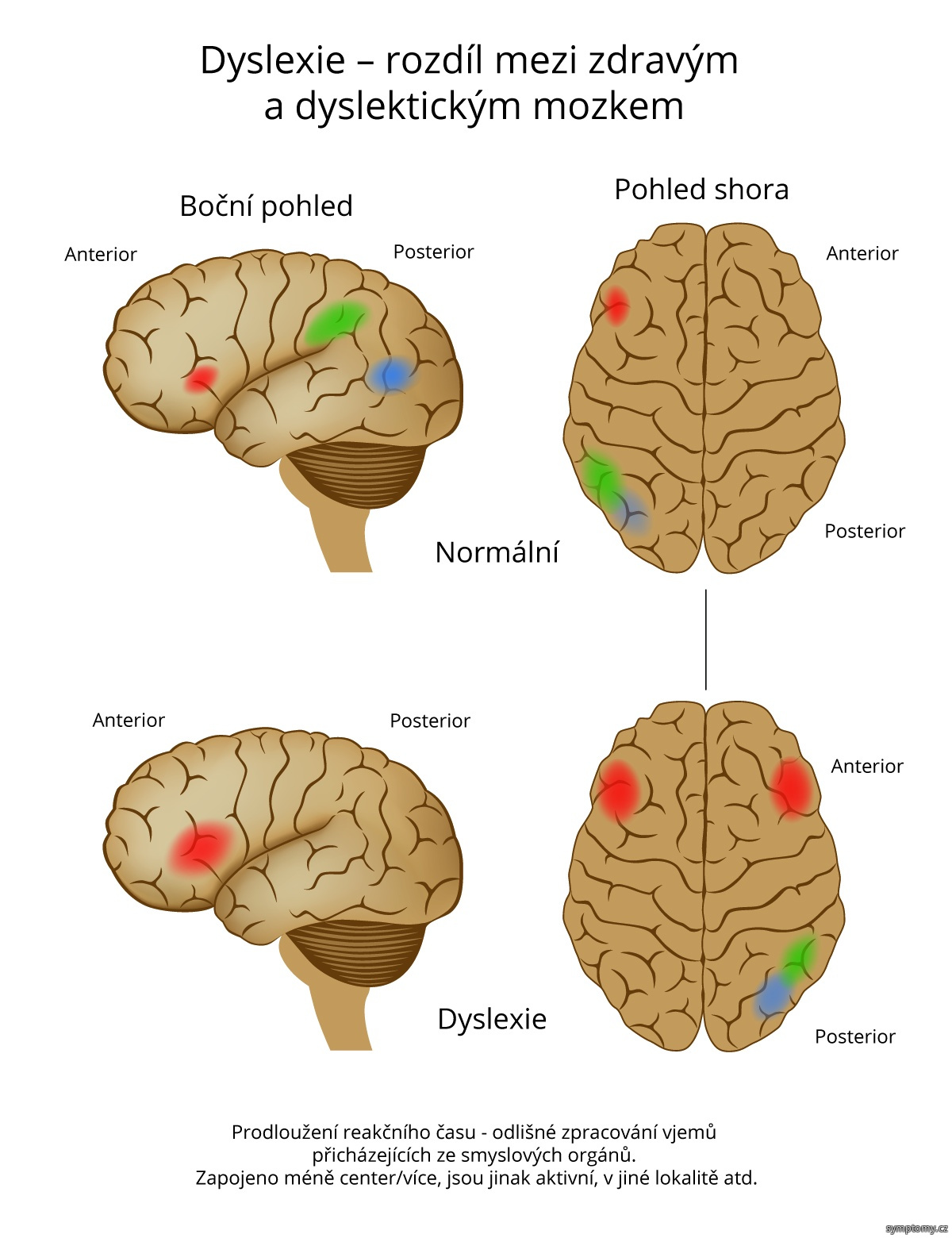 Dyslexie - rozdíl mezi zdravým a dyslektickým mozkem