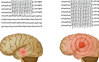 Epilepsie